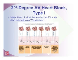 2nd-Degree AV Heart Block,
Type I
• Intermittent block at the level of the AV node
• Also referred to as Wenckebach
 