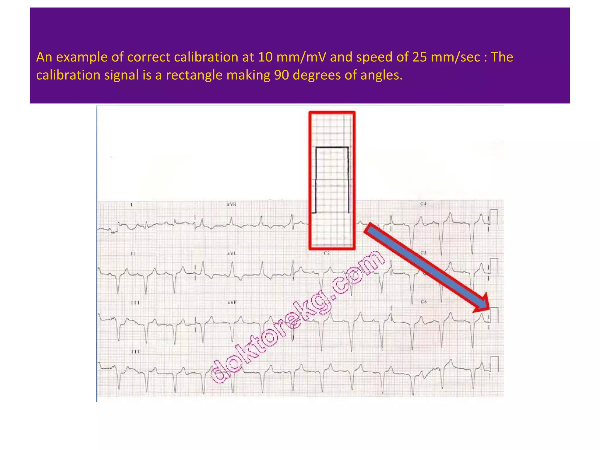 An example of correct calibration at 10 mm/mV and speed of 25 mm/sec : The
calibration signal is a rectangle making 90 degrees of angles.
 