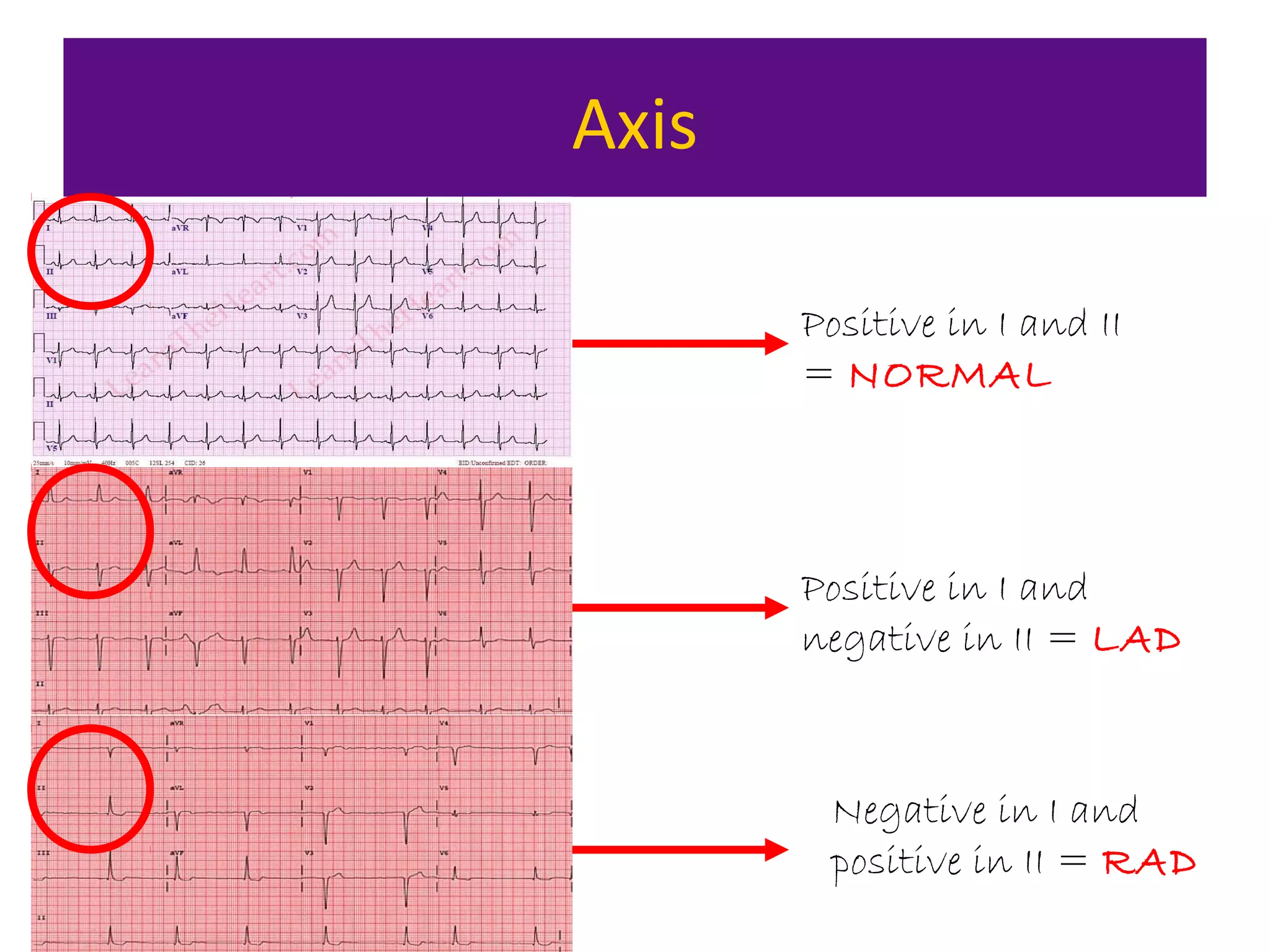 Axis
Positive in I and II
= NORMAL
Positive in I and
negative in II = LAD
Negative in I and
positive in II = RAD
 