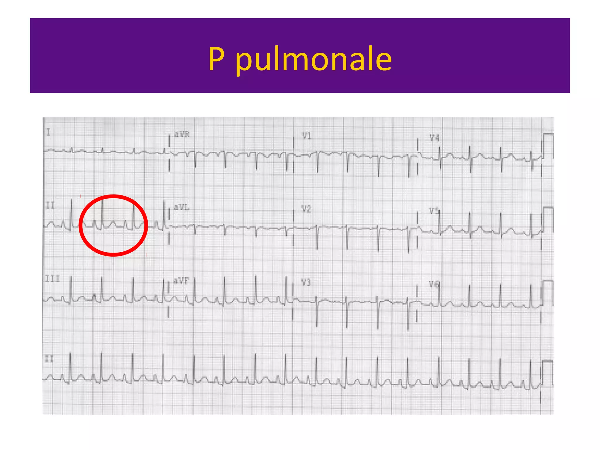 P pulmonale
 