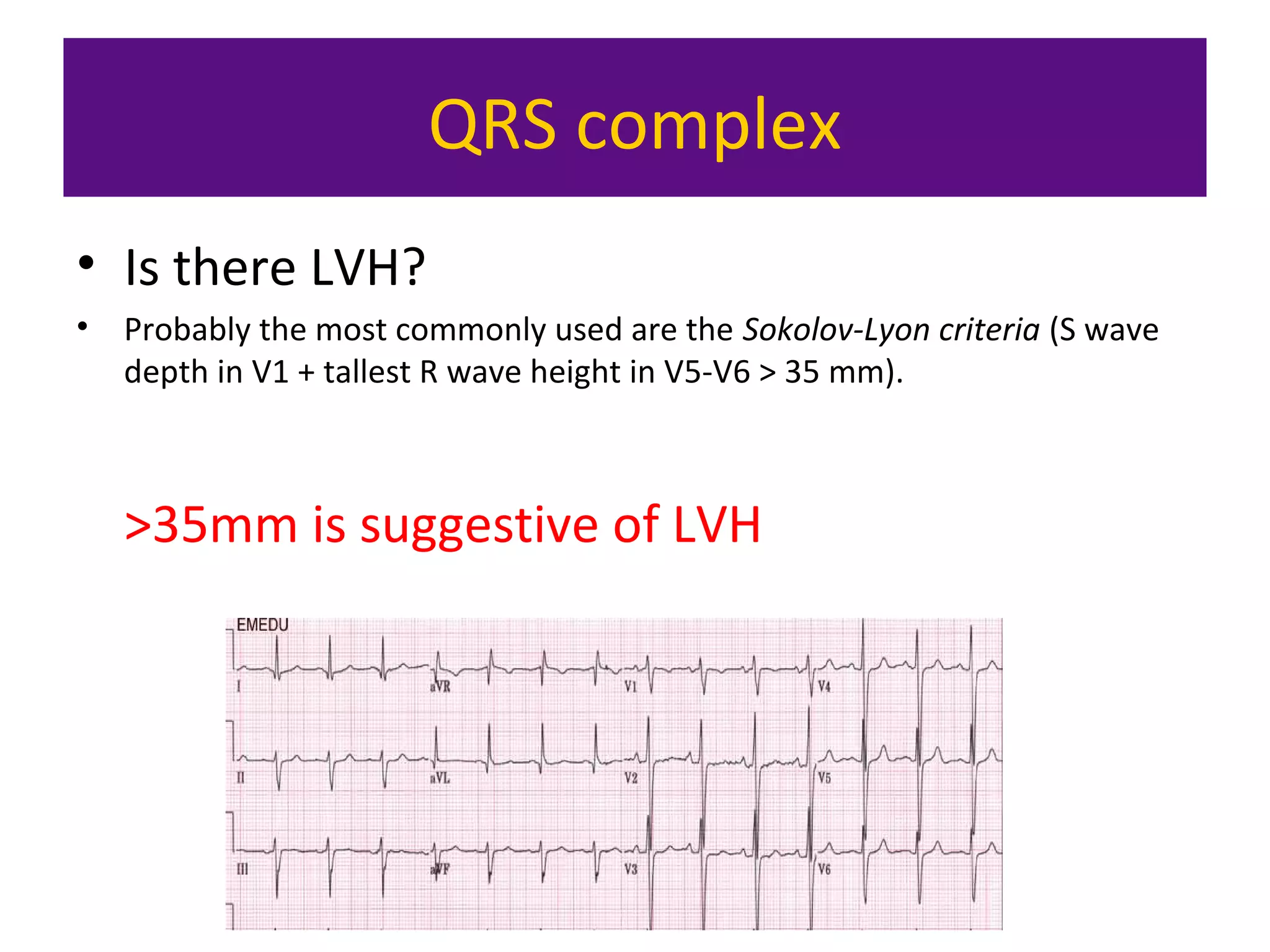 QRS complex
• Is there LVH?
• Probably the most commonly used are the Sokolov-Lyon criteria (S wave
depth in V1 + tallest R wave height in V5-V6 > 35 mm).
>35mm is suggestive of LVH
 