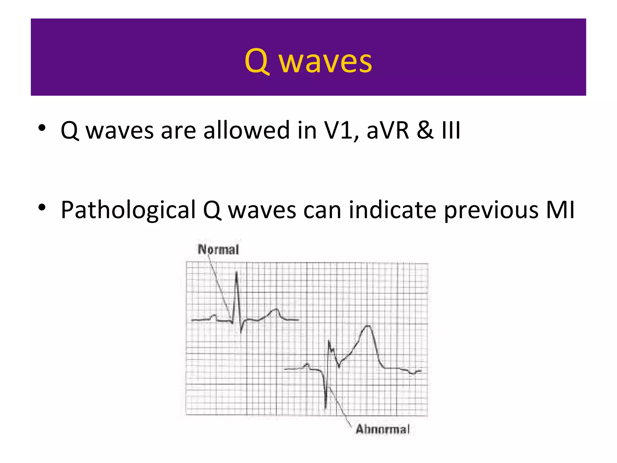 Q waves
• Q waves are allowed in V1, aVR & III
• Pathological Q waves can indicate previous MI
 