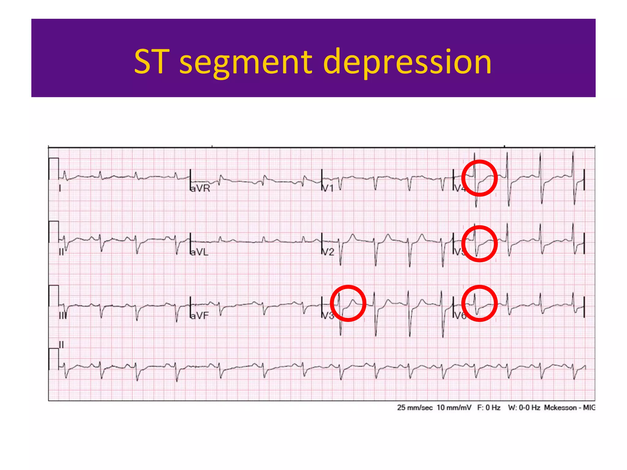 ST segment depression
 
