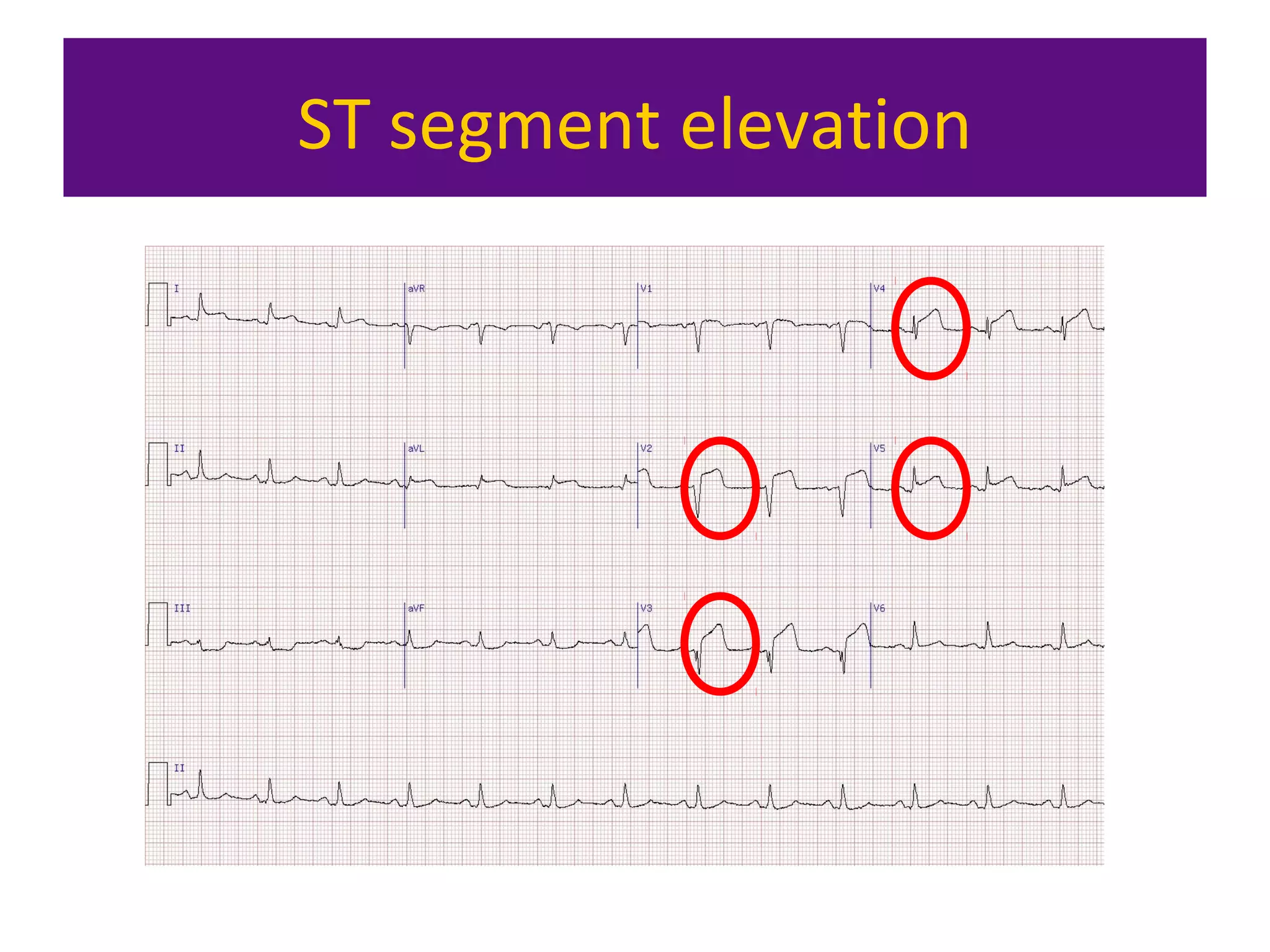 ST segment elevation
 