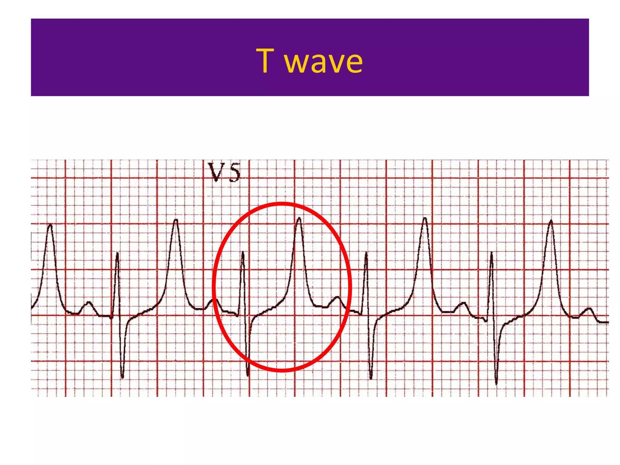T wave
 