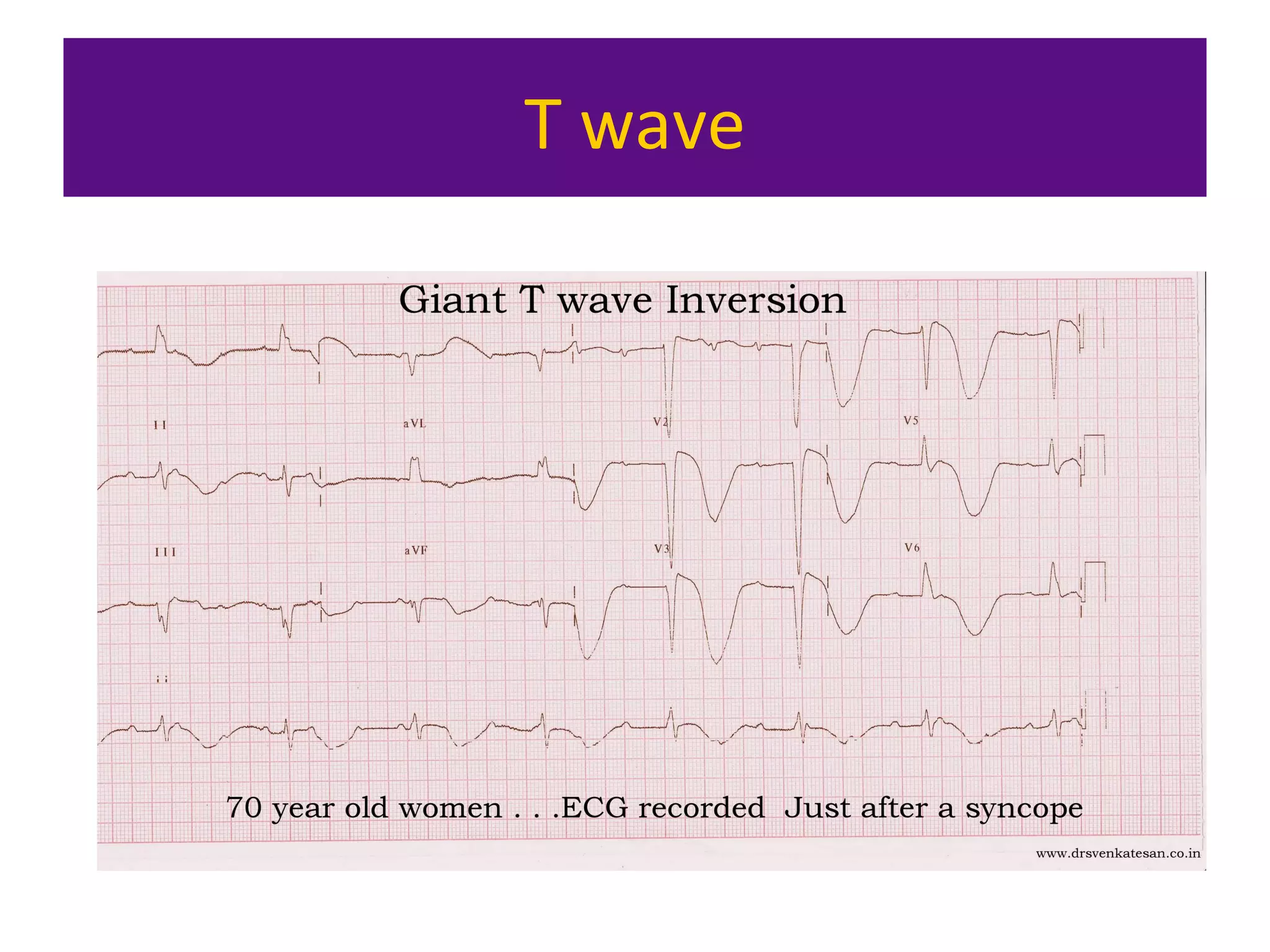 T wave
 