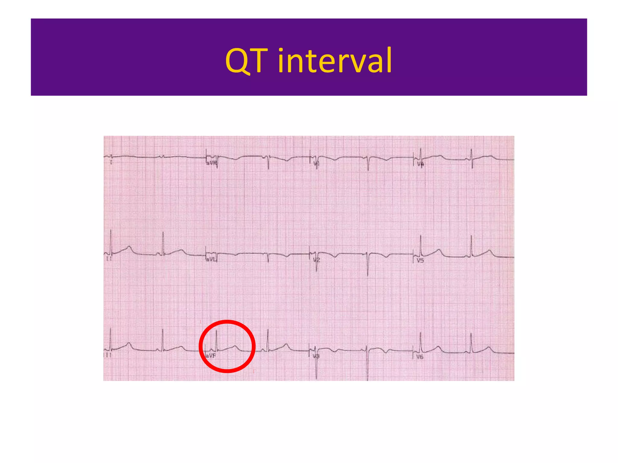 QT interval
 