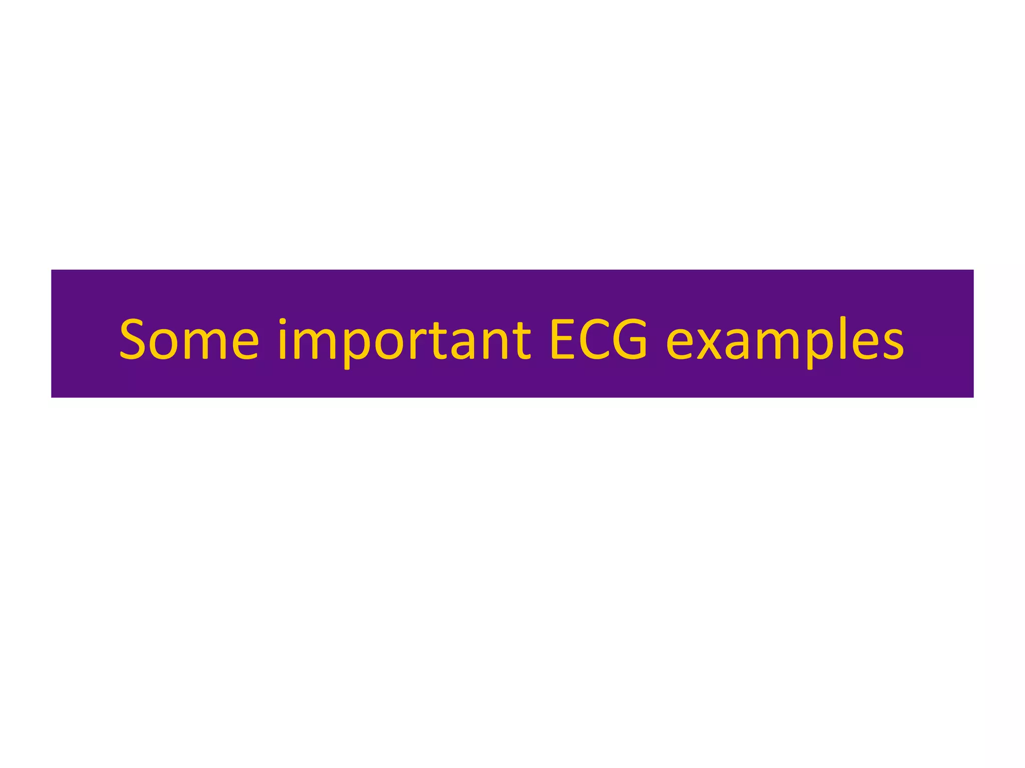 Some important ECG examples
 