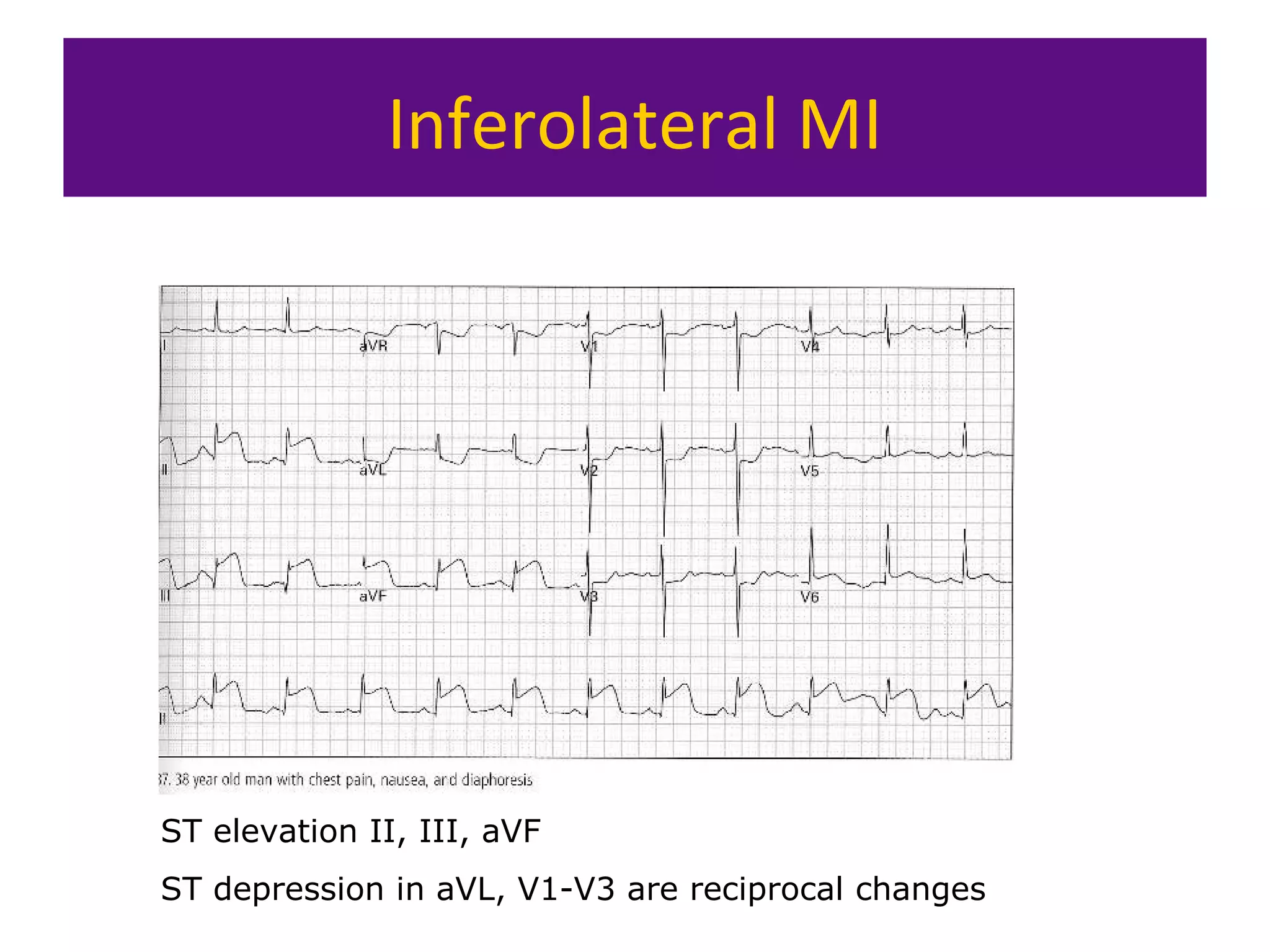 Inferolateral MI
ST elevation II, III, aVF
ST depression in aVL, V1-V3 are reciprocal changes
 
