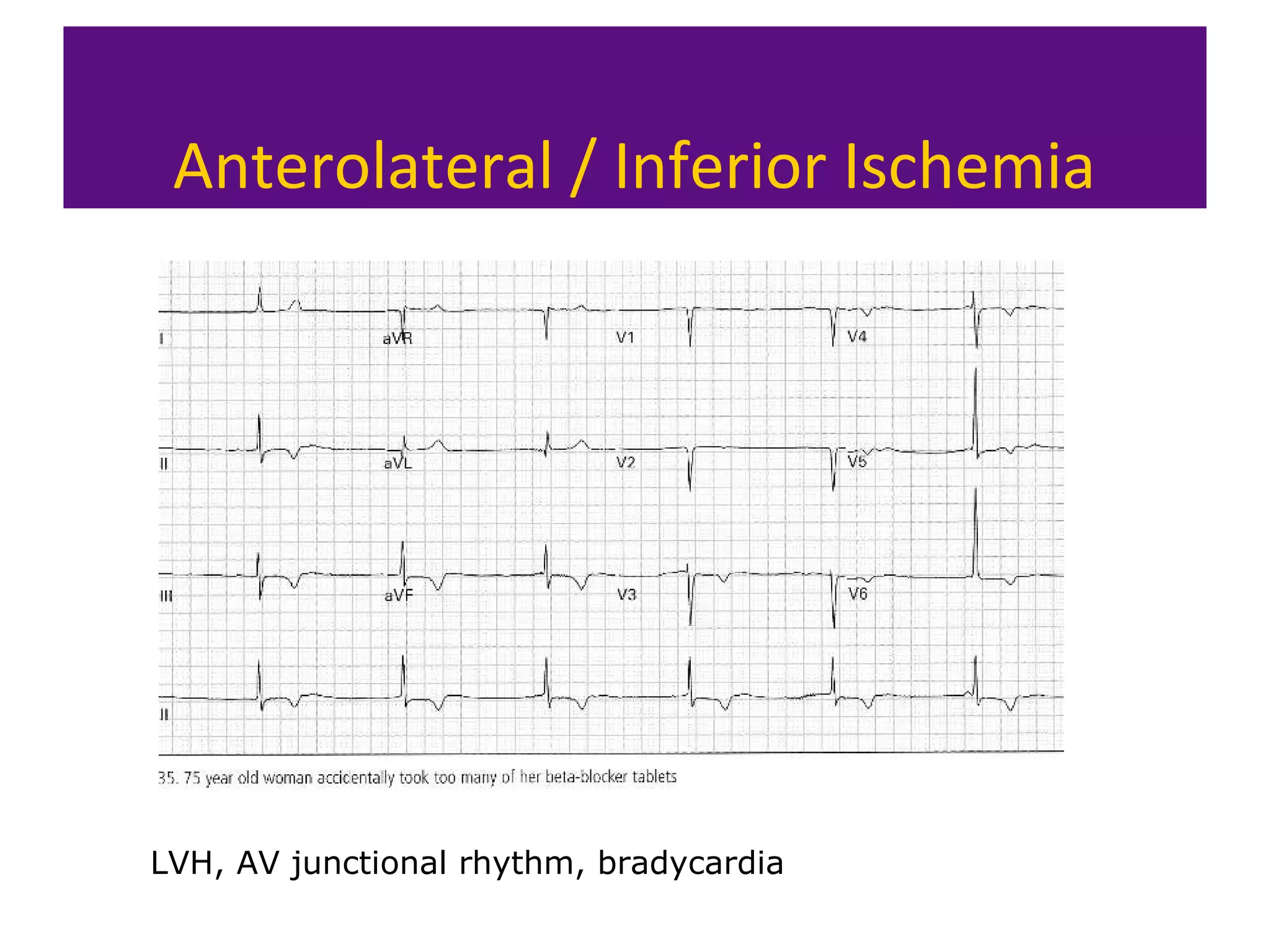 Anterolateral / Inferior Ischemia
LVH, AV junctional rhythm, bradycardia
 