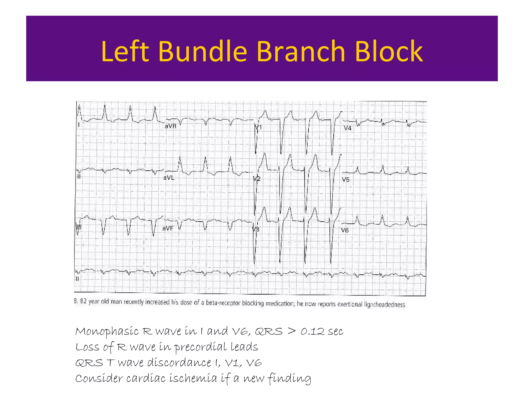 Left Bundle Branch Block
Monophasic R wave in I and V6, QRS > 0.12 sec
Loss of R wave in precordial leads
QRS T wave discordance I, V1, V6
Consider cardiac ischemia if a new finding
 
