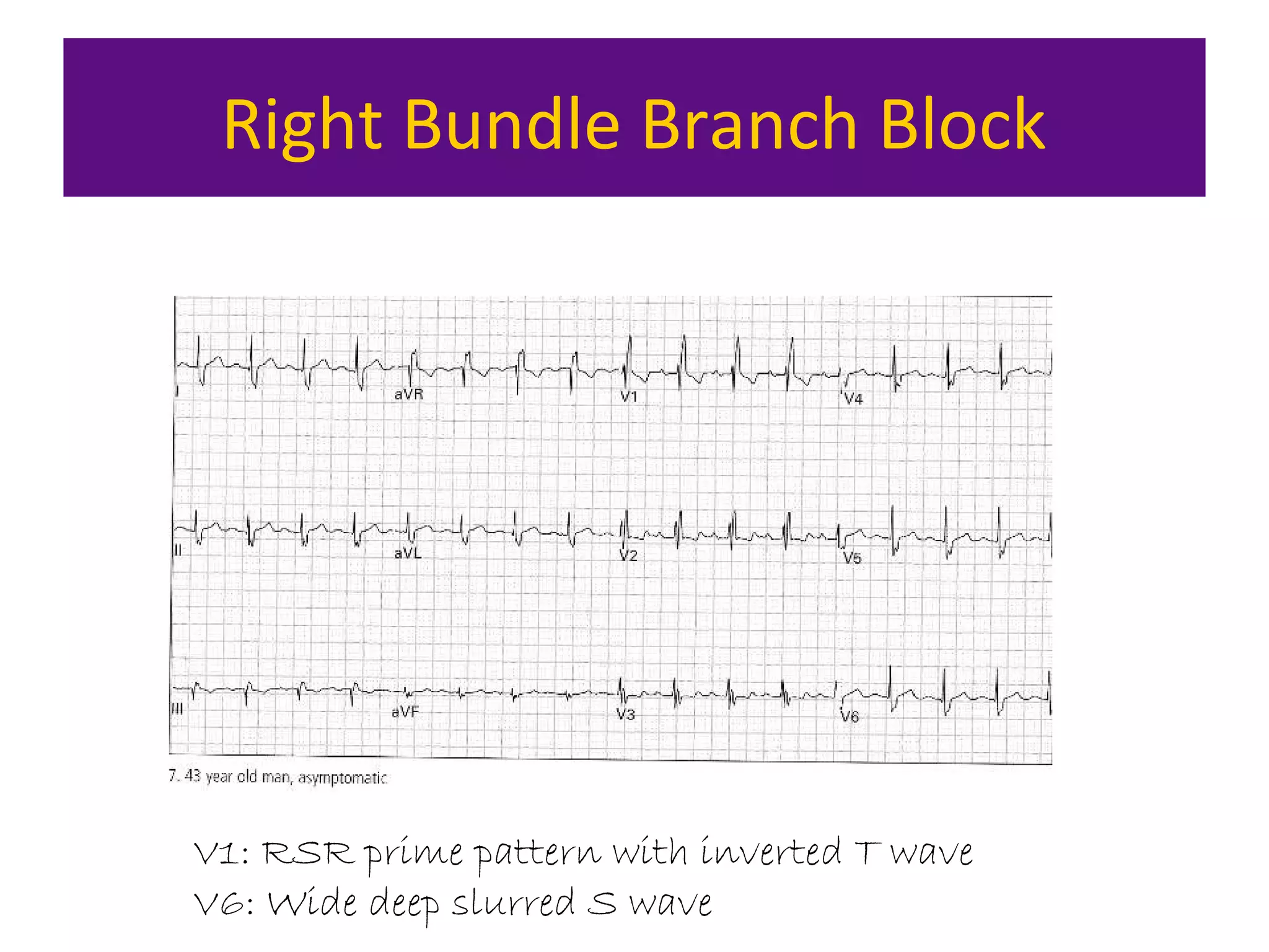 Right Bundle Branch Block
V1: RSR prime pattern with inverted T wave
V6: Wide deep slurred S wave
 