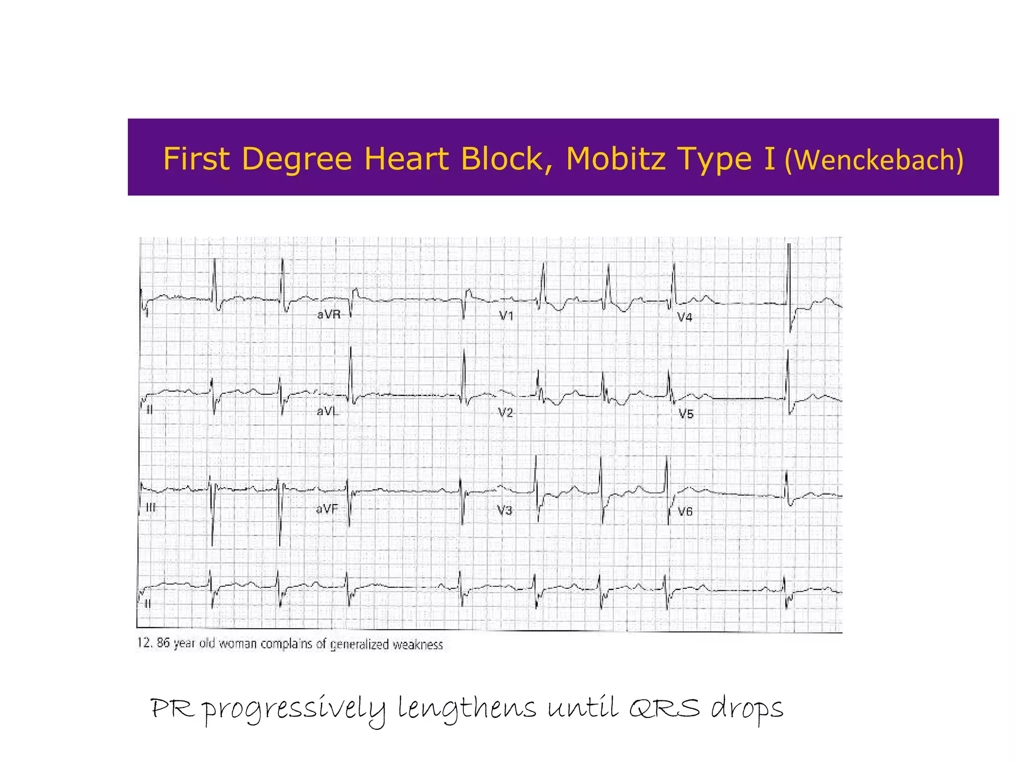 First Degree Heart Block, Mobitz Type I (Wenckebach)
PR progressively lengthens until QRS drops
 