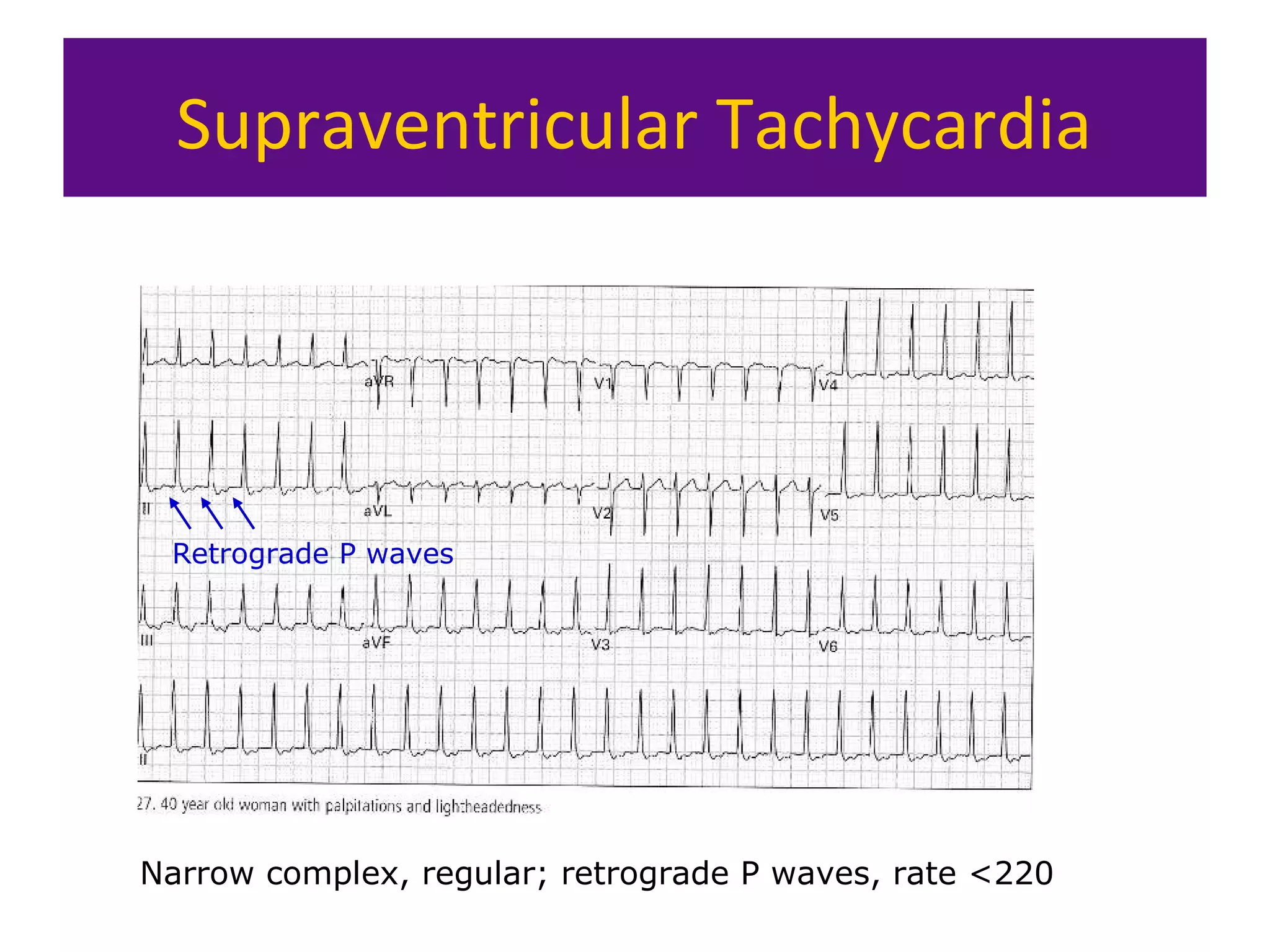 Supraventricular Tachycardia
Narrow complex, regular; retrograde P waves, rate <220
Retrograde P waves
 