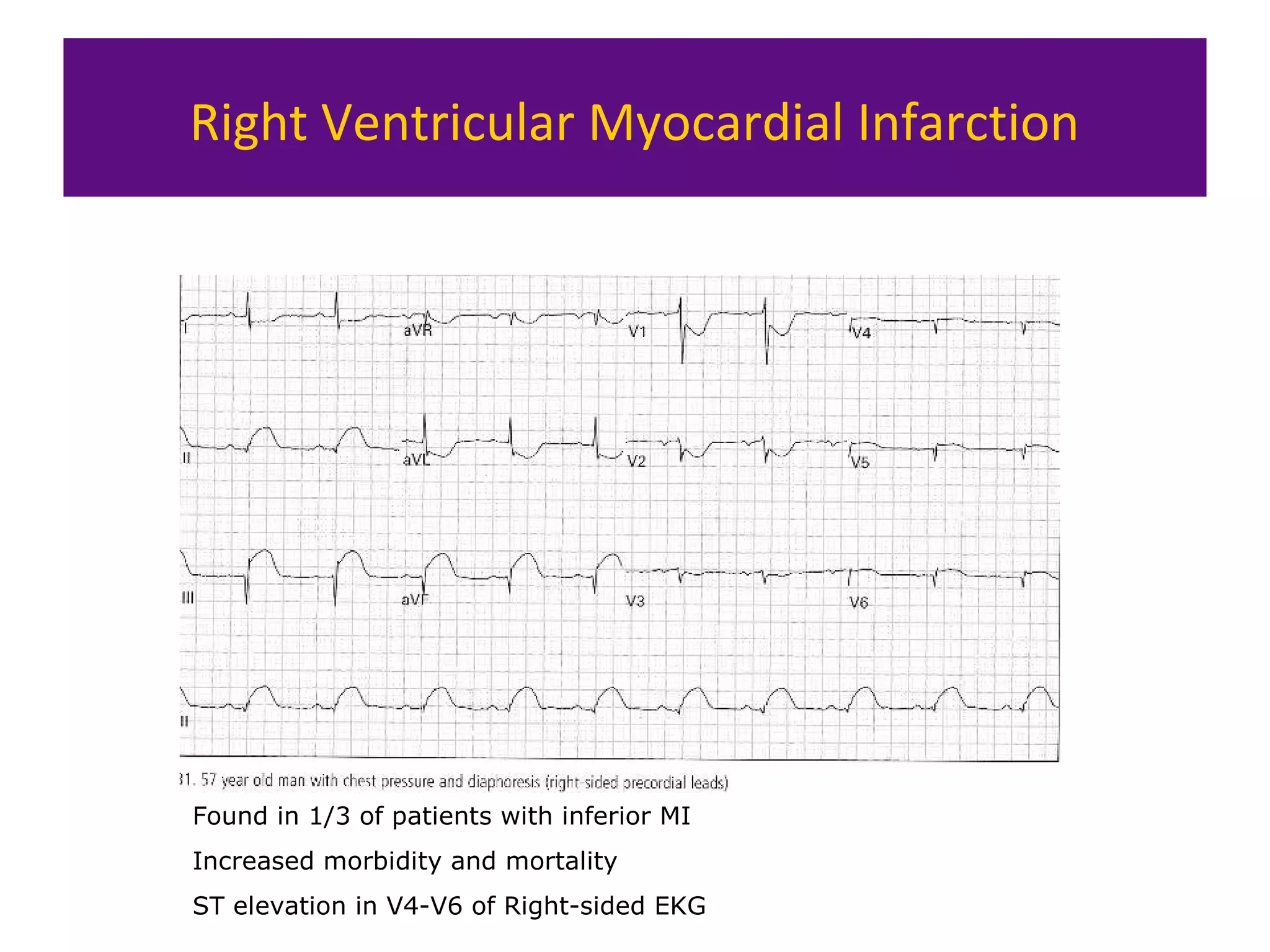 Right Ventricular Myocardial Infarction
Found in 1/3 of patients with inferior MI
Increased morbidity and mortality
ST elevation in V4-V6 of Right-sided EKG
 