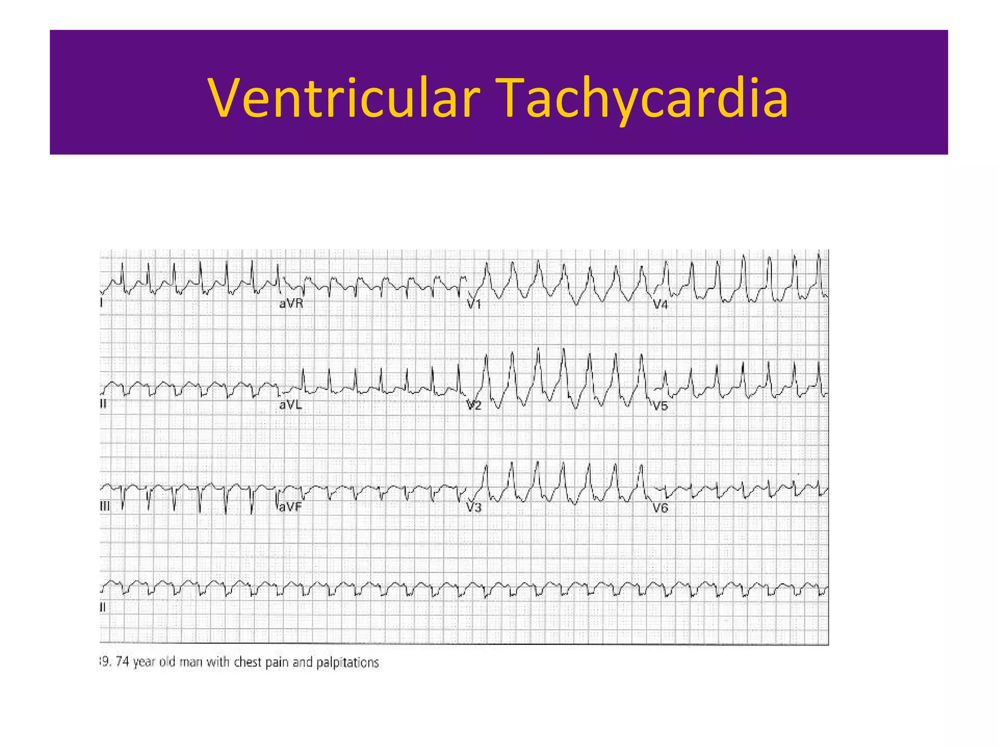 Ventricular Tachycardia
 