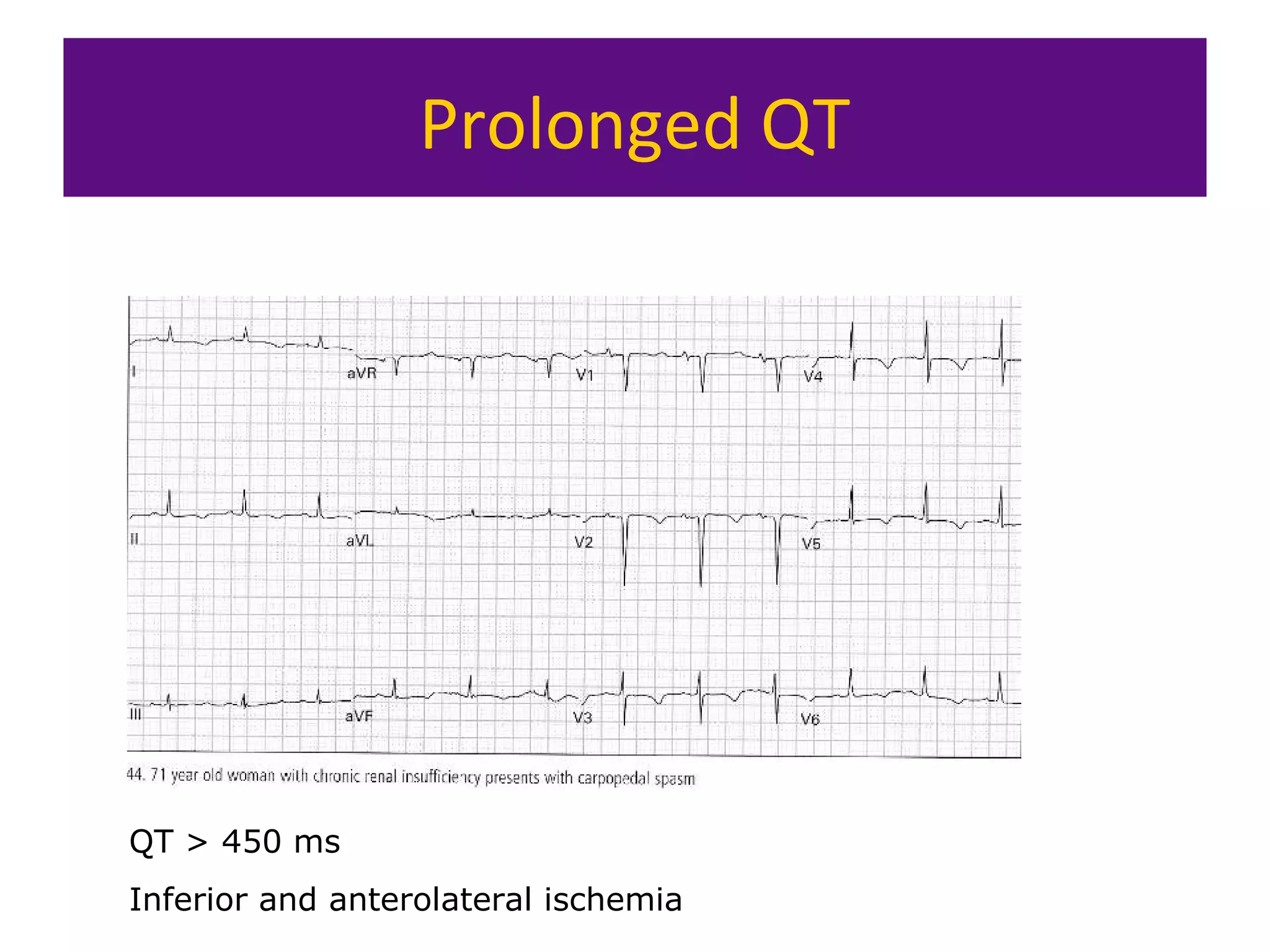 Prolonged QT
QT > 450 ms
Inferior and anterolateral ischemia
 