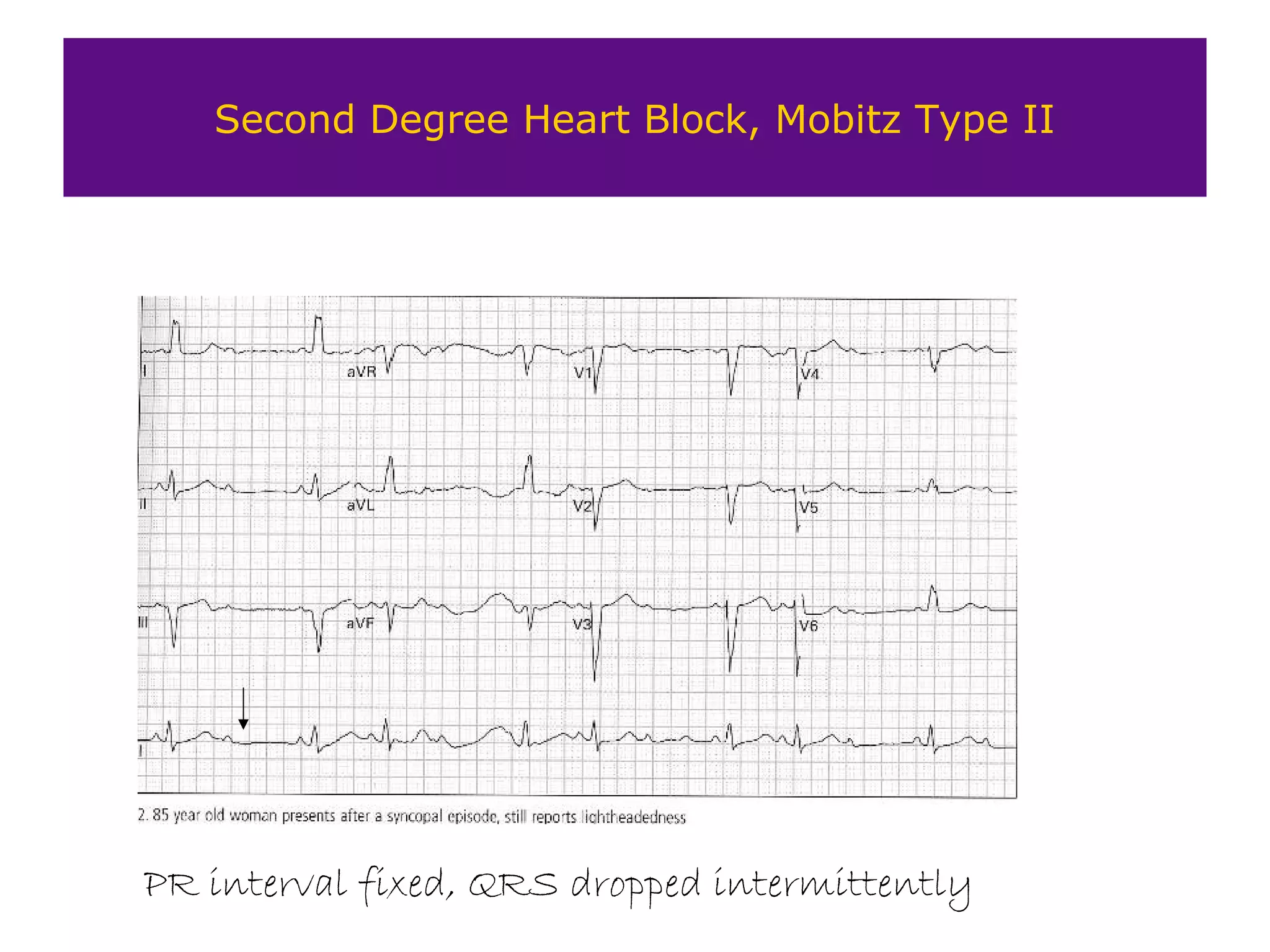 Second Degree Heart Block, Mobitz Type II
PR interval fixed, QRS dropped intermittently
 