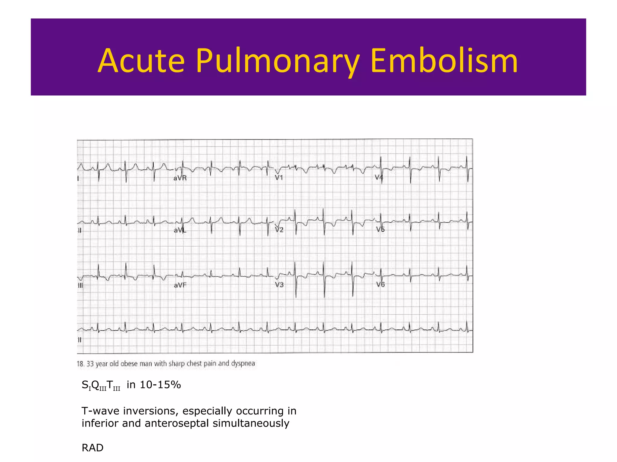 Acute Pulmonary Embolism
SIQIIITIII in 10-15%
T-wave inversions, especially occurring in
inferior and anteroseptal simultaneously
RAD
 