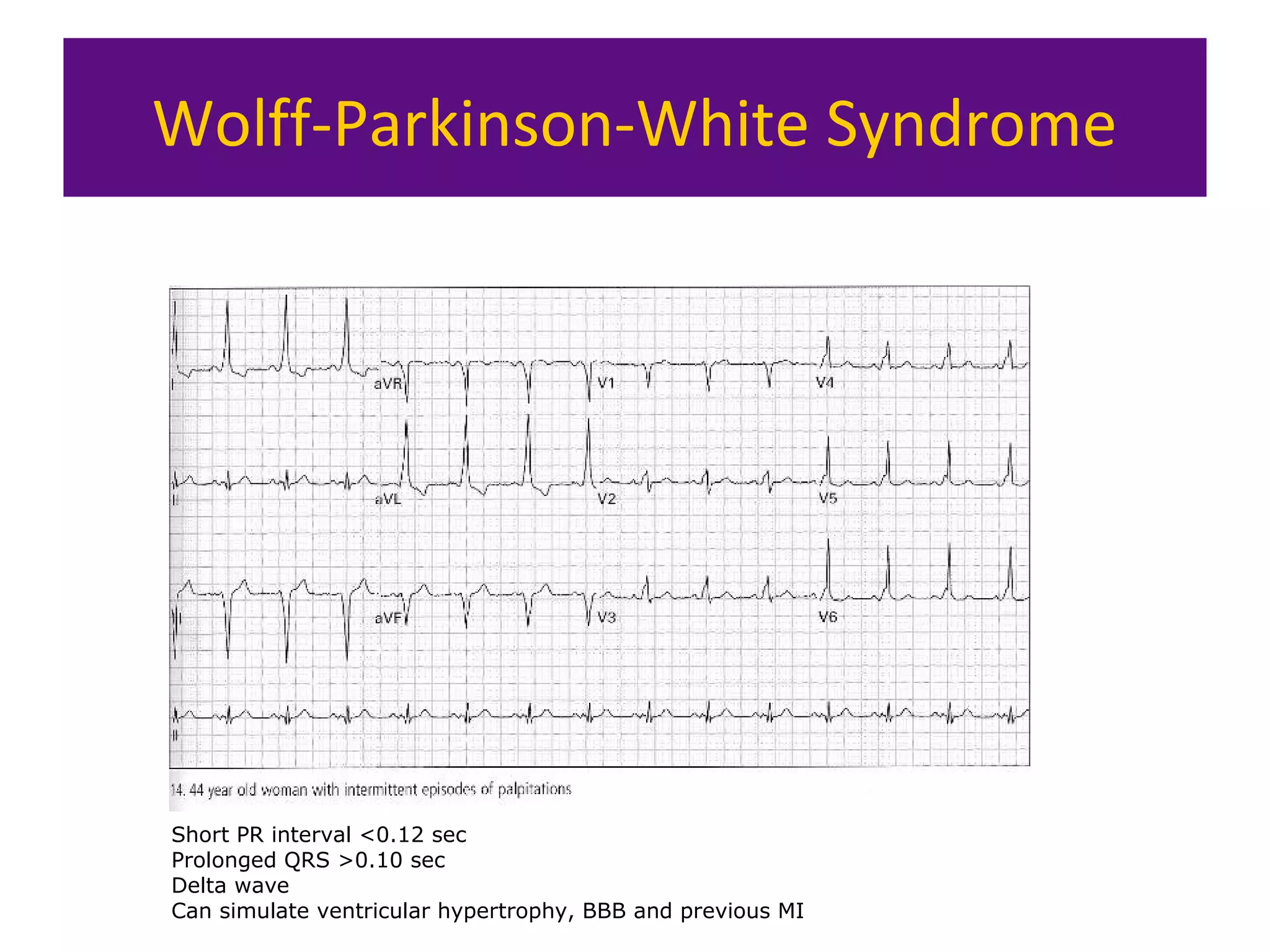 Wolff-Parkinson-White Syndrome
Short PR interval <0.12 sec
Prolonged QRS >0.10 sec
Delta wave
Can simulate ventricular hypertrophy, BBB and previous MI
 