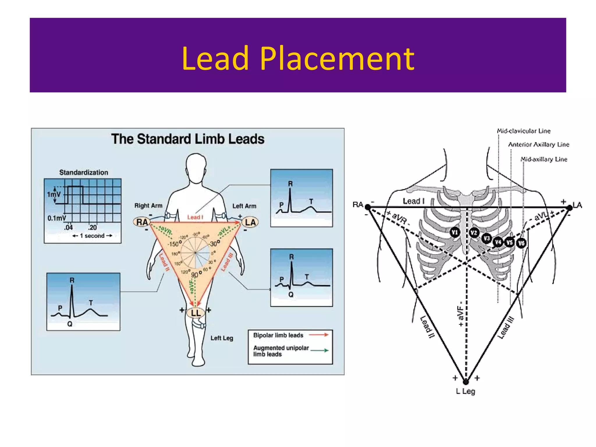 Lead Placement
 