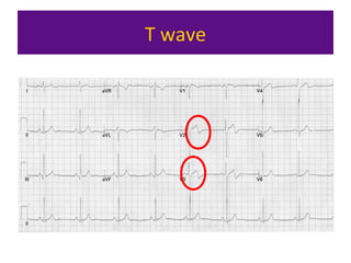 Ecg interpretation | PPT