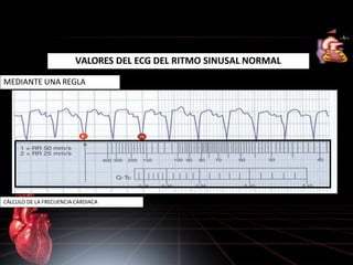 VALORES DEL ECG DEL RITMO SINUSAL NORMAL
CÁLCULO DE LA FRECUENCIA CARDIACA
MEDIANTE UNA REGLA
 