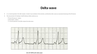 ECG FINAL n akakakakkkakaoppakak(3).pptx