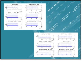Ecg Signal Processing | PPTX