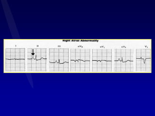 Ecg final the best | PPTX
