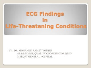 ECG Findings
in
Life-Threatening Conditions

BY / DR. MOHAMED RAMZY YOUSEF
ER RESIDENT, QUALITY COORDINATOR QPSD
MEEQAT GENERAL HOSPITAL

 