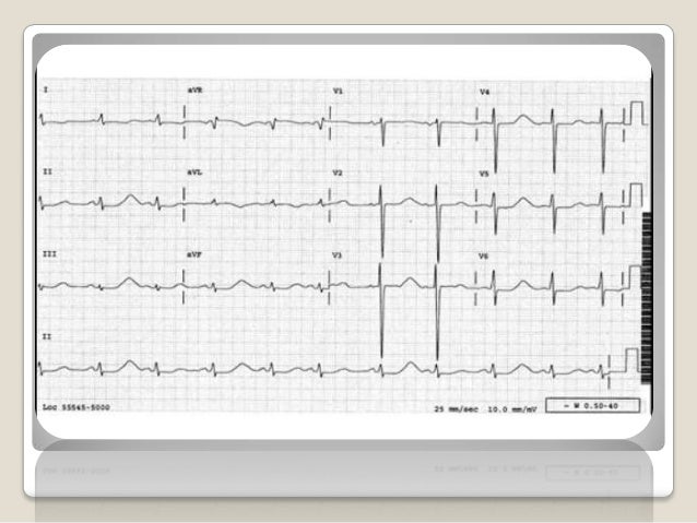 Ecg findings in life threatening conditions