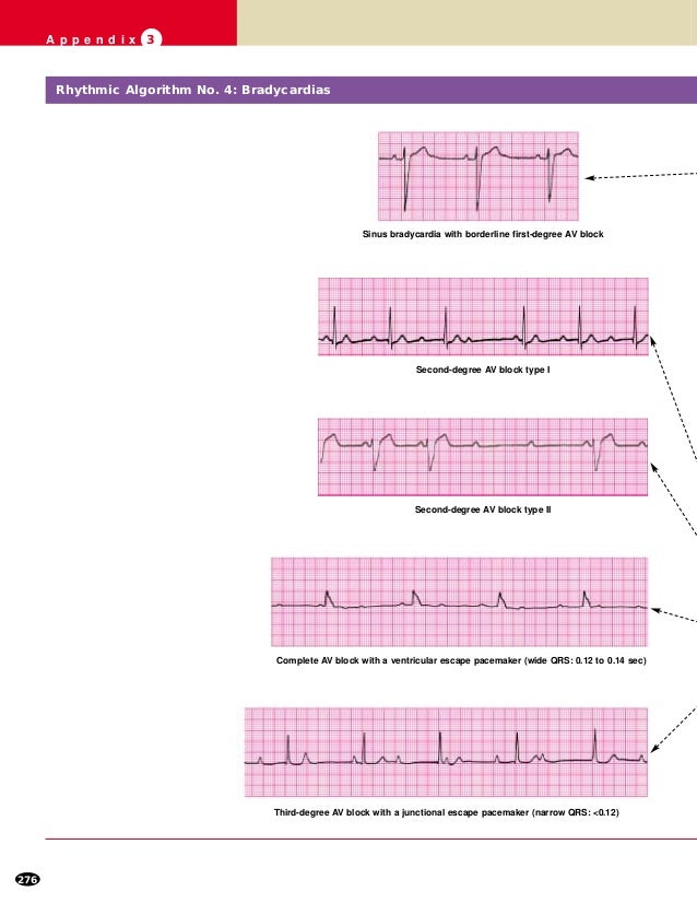Ecg For Acls Ecg For Acls