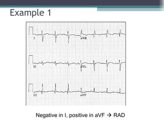 Ecg for beginners | PPT