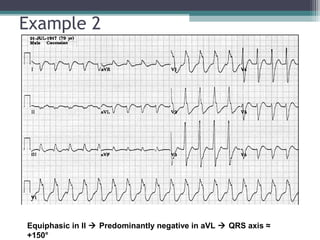 Ecg for beginners | PPT