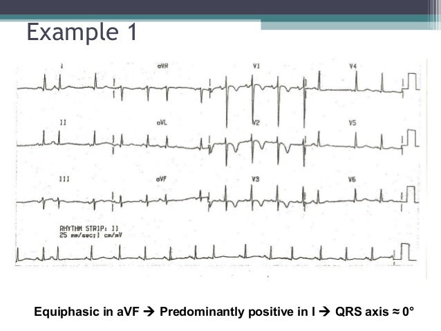 Ecg For Beginners