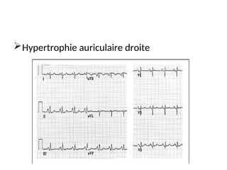 Hypertrophie auriculaire droite
 