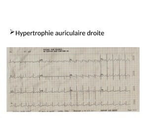 Hypertrophie auriculaire droite
 