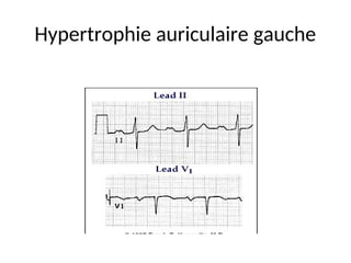 Hypertrophie auriculaire gauche
 