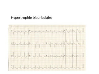 Hypertrophie biauriculaire
 