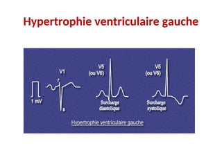 Hypertrophie ventriculaire gauche
 