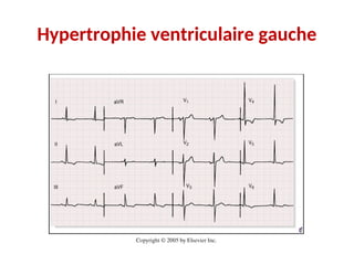 Hypertrophie ventriculaire gauche
 
