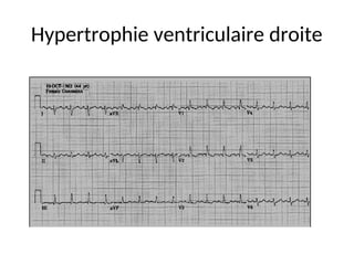Hypertrophie ventriculaire droite
 