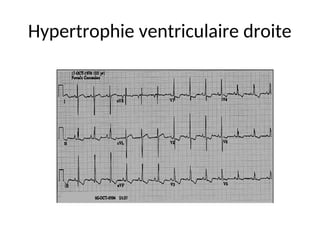 Hypertrophie ventriculaire droite
 