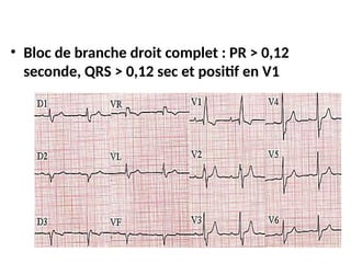 • Bloc de branche droit complet : PR > 0,12
seconde, QRS > 0,12 sec et positif en V1
 
