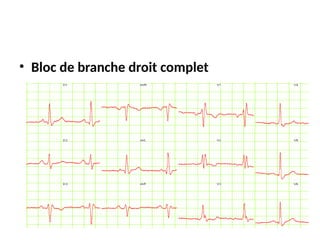• Bloc de branche droit complet
 