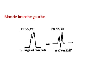 Bloc de branche gauche
 