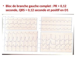 • Bloc de branche gauche complet : PR > 0,12
seconde, QRS > 0,12 seconde et positif en D1
 