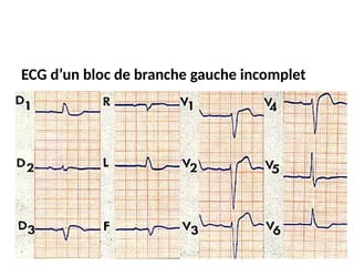 ECG d’un bloc de branche gauche incomplet
 