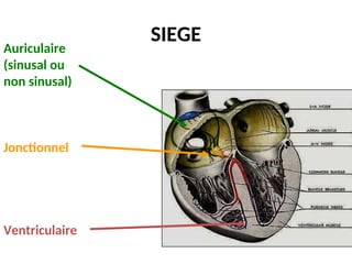 SIEGE
Auriculaire
(sinusal ou
non sinusal)
Jonctionnel
Ventriculaire
 